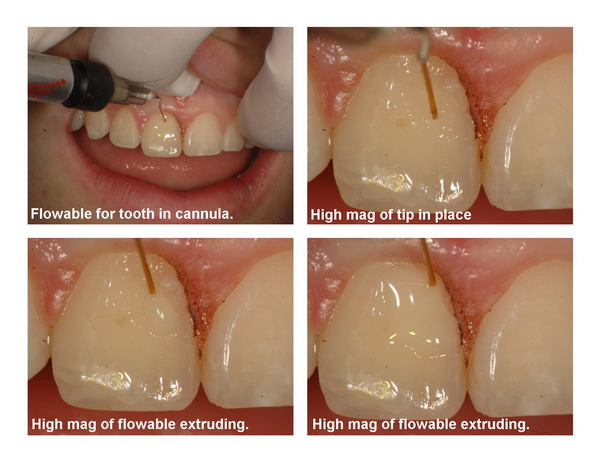 Gingivectomy and restoration Page7_resize.jpg